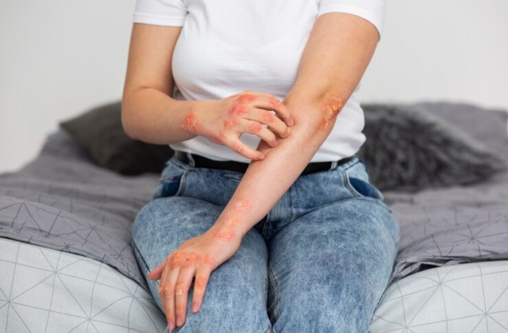 Identify and Manage Atopic Dermatitis Symptoms in Adults