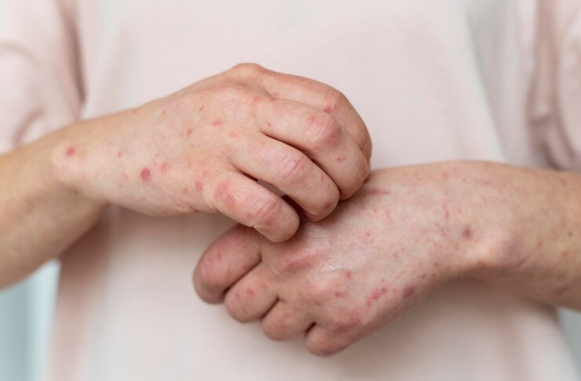 Reason Behind Itch: Eczema Causes and Symptoms