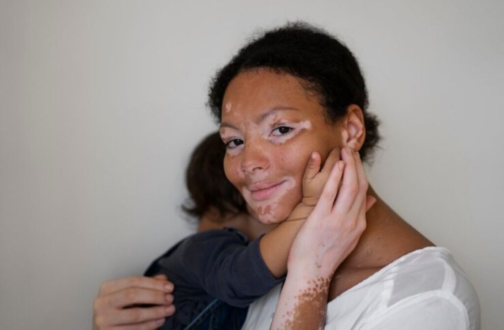 Understanding Vitiligo: Causes, Symptoms, and Treatment