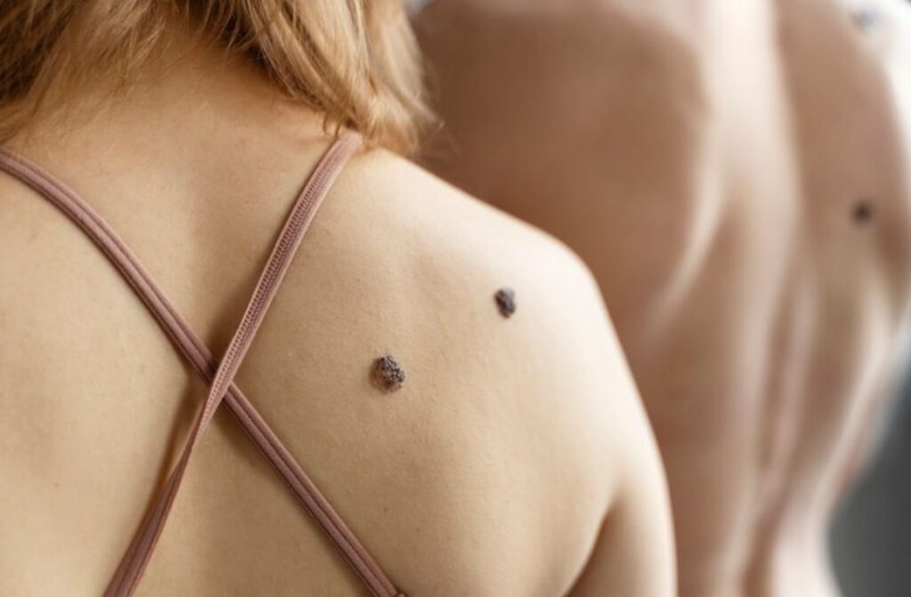 What is a skin tag? How to remove it?