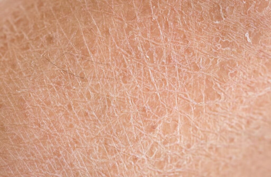 Dry skin causes: how to identify and treat them?