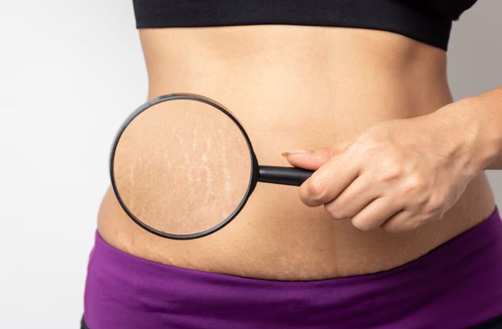 The Best Stretch Mark Removal Treatment for Glowing Skin