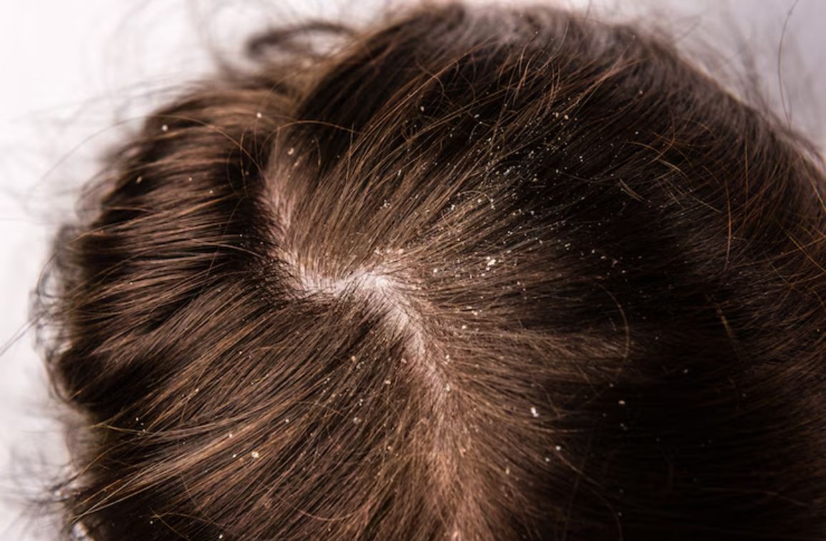 Why Viara for Anti-Dandruff Treatment in Hyderabad?