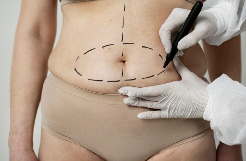 What is Liposuction and How Can It Transform One’s Body?