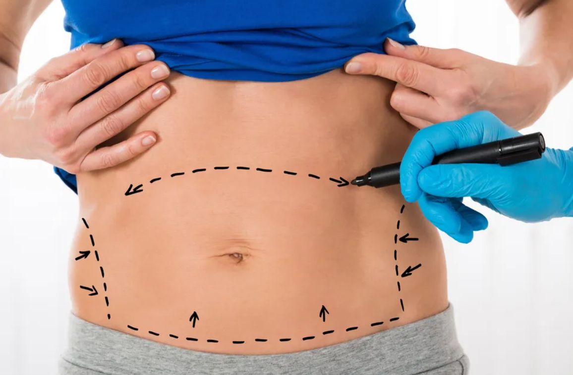 Risks and Benefits of Tummy Tuck Surgery