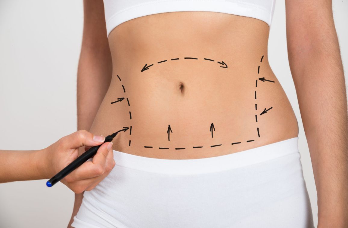 What is Liposuction and How Can It Transform One’s Body?