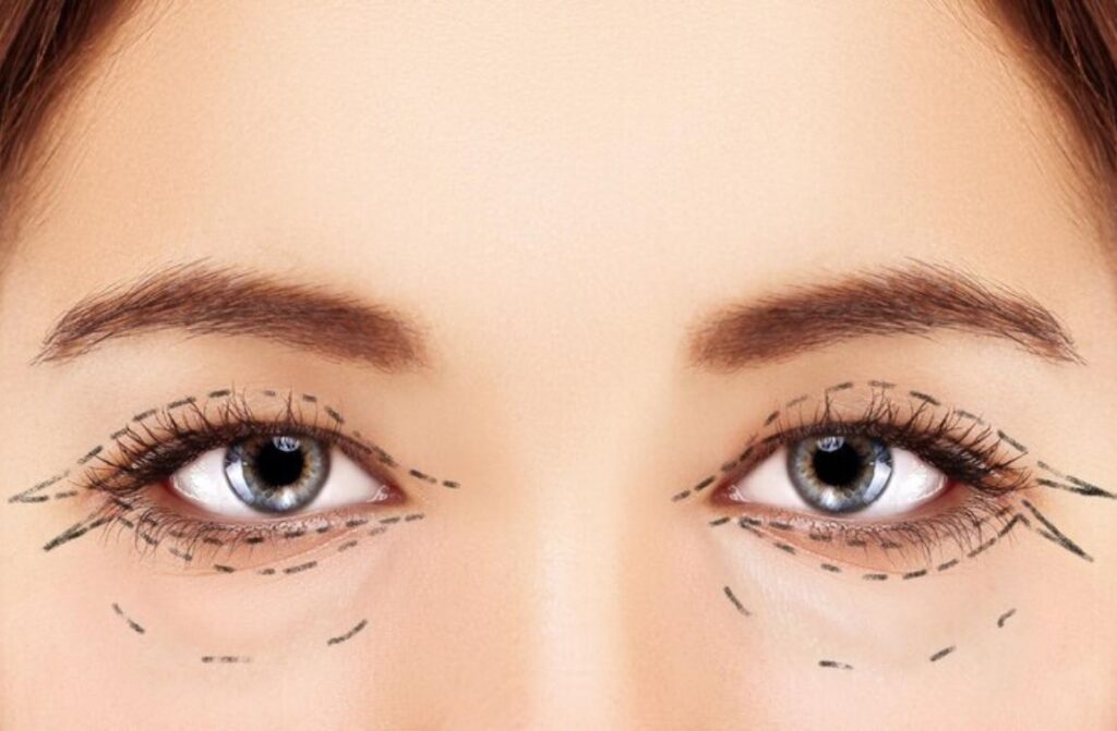 Blepharoplasty surgery Explained: Procedure, Recovery, Results