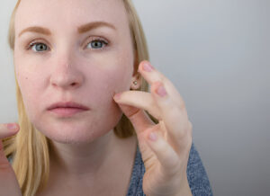 best pigmentation treatment in Hyderabad