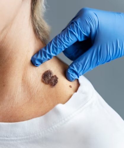 Skin Tags and Warts - Viara Clinics